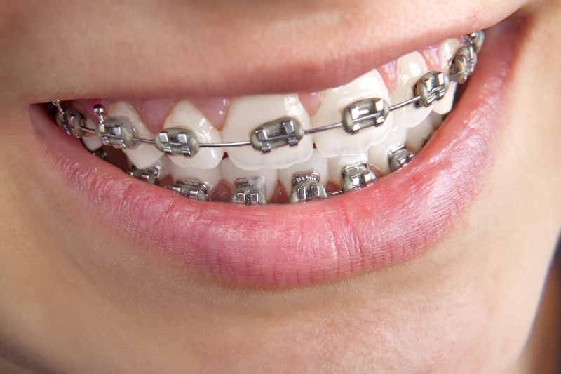 Official FastBraces Forest Dentistry, San Jose Dentist