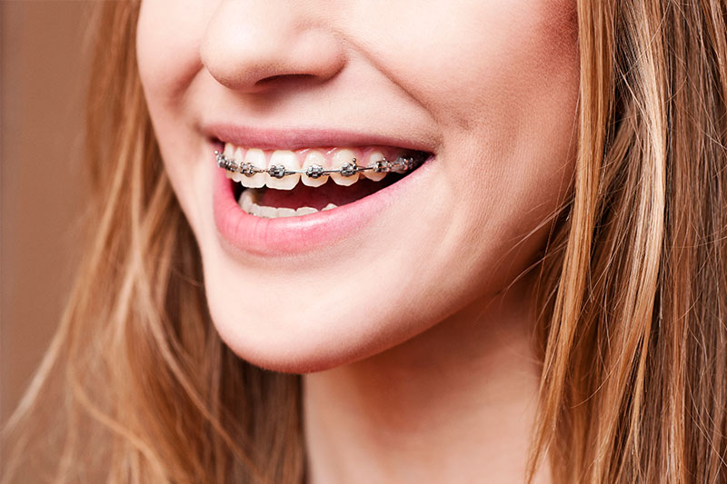 Orthodontics San Jose, CA – Braces 95128