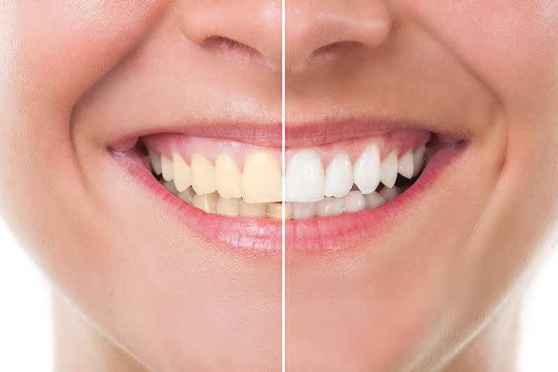 Teeth Whitening in San Jose, CA, 95128